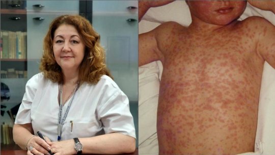 Simin Aysel Florescu: "Eu, ca studentă la medicină și tânăr medic și, ulterior, până în anii 2000, n-am văzut rujeole în România. Rujeola era văzută doar în atlas, ne povesteau seniorii noștri cum arăta rujeola"
